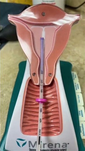 IUD insertion #obgyn #womenshealth #femininehealth #iud #iudinsertion #birthcontrol