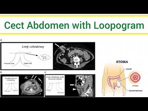 Cect abdomen and loopogram intestinal injury patient.