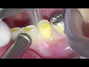 Tooth preparation for PFM crown on #34, PFM crown을 위한 치아삭제, #toothpreparation#OxO4k#dentalvideo