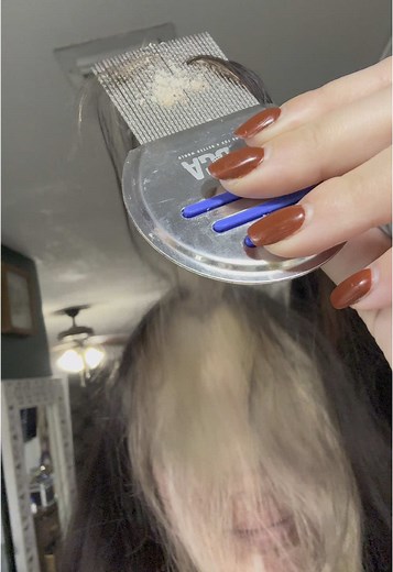 Effective Dandruff Removal Tips for Scalp Psoriasis