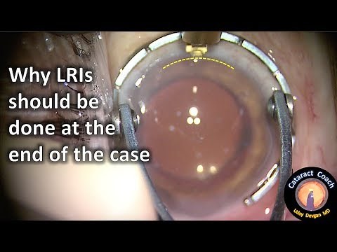 This is why I do LRIs (Limbal Relaxing Incisions) at the end of the Cataract Surgery
