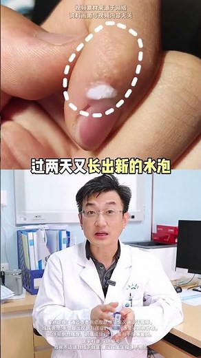 手上长了小水泡又痒又痛，手也看着不好看，医生教你有效处理 #汗疱疹 #手上长小水泡 #春夏换季 #医生科普