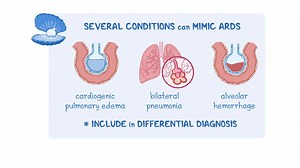 Video: Acute respiratory distress syndrome: Clinical sciences - Video Explanation! | Osmosis | Osmosis