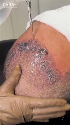 Are You Washing Your Hair Wrong After Transplant? #hairtransplant #hairgrowth #shorts