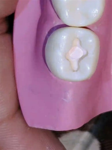 Mixing Glass Ionomer and Calcium Hydroxide