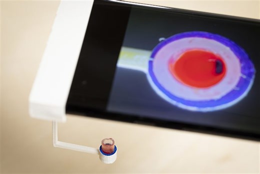 Phone app can help detect blood's ability to clot - UW Medicine - Newsroom