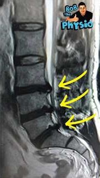 L4 L5 – L5 S1 DISC HERNIATION RECOVERY (NO SURGERY) #sciatica