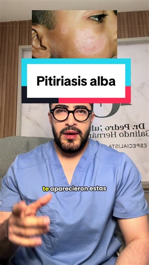 Pitiriasis alba: causas, síntomas y tratamiento efectivo