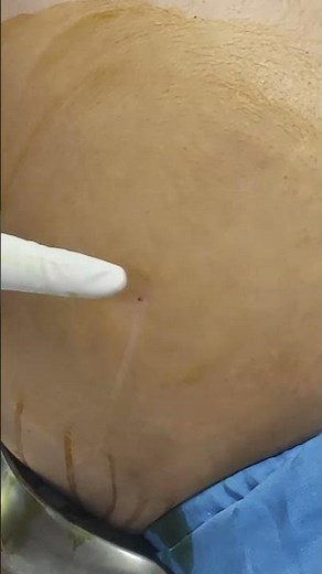 Remove abdominal water | A patient with cirrhosis | #paracentesis #ascites