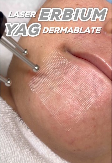 Erbium YAG Laser Treatment for Scar Reduction