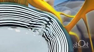 Herniated Disc | The Surgery