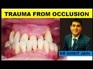 Trauma From Occlusion Perio (GRADE III FREMITUS)2019 II Dr Somit Jain