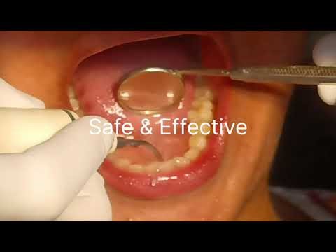 Scaling से दांत कमजोर होते हैं?सचजानिए!3 मिनट में दांत साफ–UltrasonicScaling Explained#TheDentalGuru