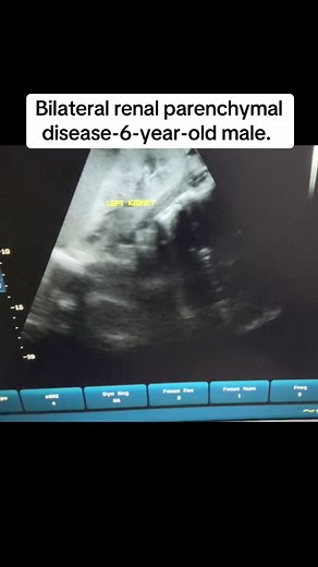 Understanding Bilateral Renal Parenchymal Disease in Children