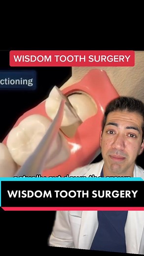 Wisdom Tooth Removal Under Local Anesthesia: Quick Guide