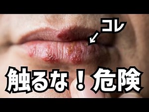 [Herpes labialis] Detailed explanation of the causes and treatment of herpes, as well as common p...