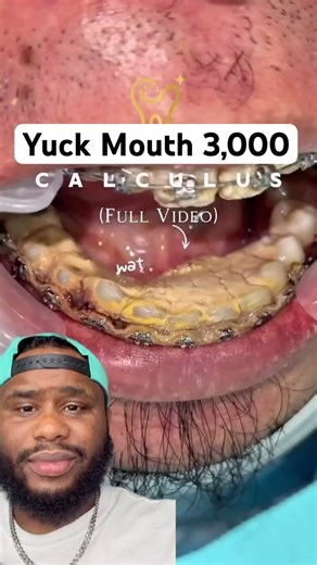 PROCESS OF REMOVING CALCIUM BUILD UP FROM TEETH