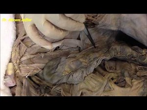 Position Of The Appendix • Video • MEDtube.net