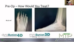 Optimize Your Distal and Proximal Hallux-Valgus Procedures with miniBunion 3D and dynaBunion 4D Lapidus