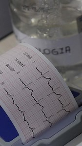 🚨 ¿Qué es un IAM y cuáles son sus signos? Dolor en el pecho, falta de aire, sudor frío… ¿sabés reconocer los síntomas de un infarto? Una consulta a tiempo puede salvar tu vida. 👉 Mirá este video informativo. #RedIAM #SignosDeInfarto #SaludJujuy #Emergencias | Ministerio de Salud de Jujuy