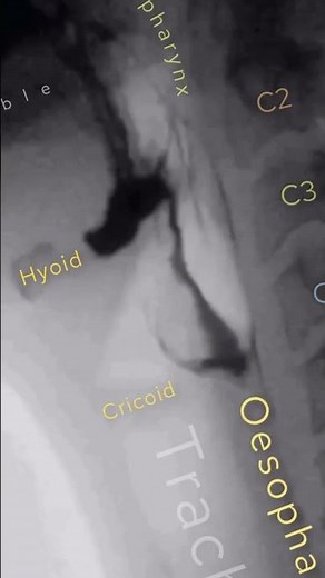 fluoroscopy of barium swallow...... by ‪@Radiographer_khan‬#fluoroscopy #radiology