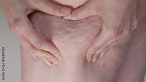 SLOW MOTION CLOSE UP MACRO: Unrecognizable overweight female pinches excess fat on her leg. Obese woman revealing the cellulite on her legs by squeezing her thigh with her hands. Serious health issue.