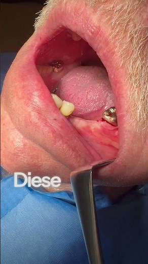 Bridge on dental implants - here's how! #dentalimplants #dentures #implants