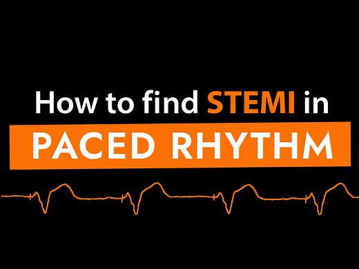 Sgarbossa Criteria for Ventricular Paced Rhythm | scanFOAM