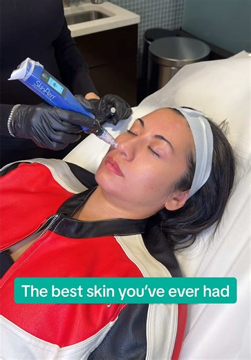 The ultimate skin cheat code ✨✨ SkinPen microneedling works by creating controlled micro-channels in the skin to stimulate collagen and elastin production, helping improve texture, pores, fine lines, and overall skin quality. We paired this treatment with PDGF, a growth factor serum that supports faster healing, reduces downtime and enhances the rejuvenating effects of microneedling. The result: smoother, healthier, more radiant skin that continues to improve as collagen rebuilds over time. 📱 C