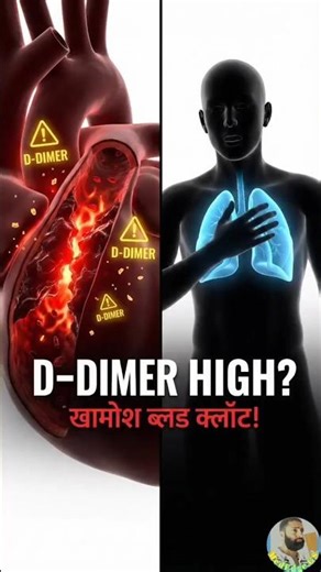 “High D-Dimer? Your Body Is Hiding Blood Clots”(Hindi