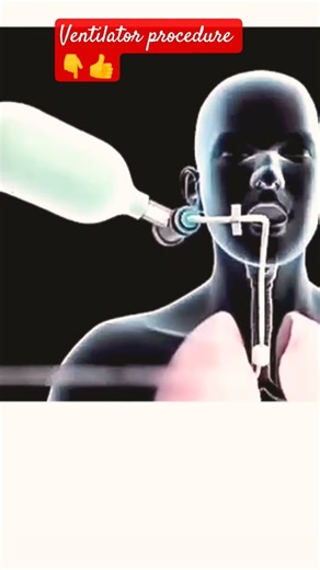 ventilator procedure🫁 👇#viral medical life #save life #artificial lungs 🫁#trending medical life 🧑‍⚕️