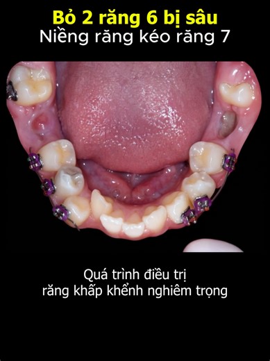 Răng số 6 bị sâu cần phải nhổ thì có niềng răng được không? #niengrang #niengrang #nhakhoa #orthodontics #braces