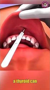 Transoral Endoscopic Thyroidectomy #thyroidectomy #medical #shorts