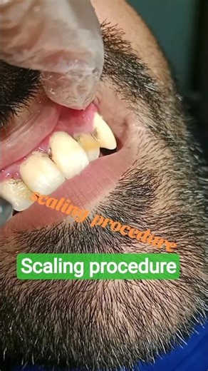 Scaling of teeth from tarter and calculus #dentist # satsfing