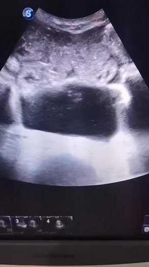 The demonstrated bowel loops appear normal in caliber with mural wall...