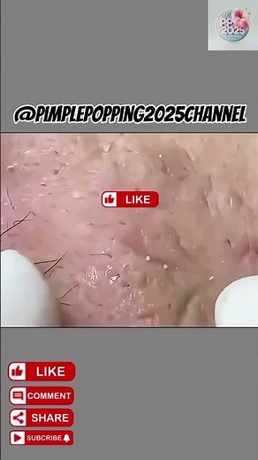 Satisfying Pimple Popping Compilation 2025 #asmrpimplepopping #satisfyingvideos #blackheadremoval