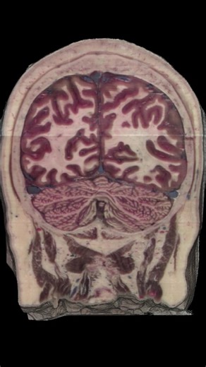 Kent on Instagram: "This visualization shows the reconstructed 3D view of the head, as a fixed clipping plane exposes the true anatomy beneath the surface as the head rotates. The image dataset used for this is publicly available via the nih website in the Visible Human Project section. If interested in more details about the original study that produced the data you can check the pinned post on my profile. I've been experimenting off and on with this publicly available dataset for the better pa