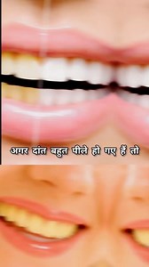 1.1M views · 8.2K reactions | Teeth whitening at home 醴 .#teethwhitening #teethcleaning #yellowteeth #teethwhiteningkit | Versatile Anamika | Facebook