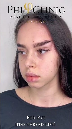 Fox Eye (PDO Threads Lift)