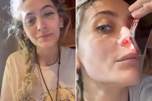 Paris Jackson reveals scary side effect of drug abuse — and why she won’t get surgery to fix it