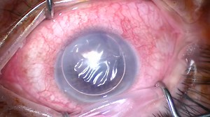 Descemet's Membrane Detachment  - Eyetube