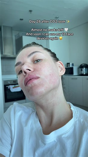 Progress After CO2 Laser Treatment on Day 28