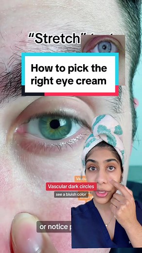 How to Choose the Best Eye Cream for Pigmented and Vascular Dark Circles