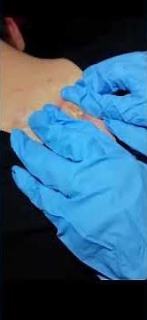 Pimple popper, Backne explosion, cyst squirting, oozing zit