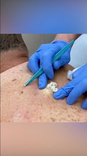 Giant Cyst in the Back Removal