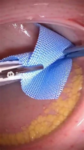 Abdominal Hernia Repair in 10 Seconds | Surgical Steps #shortvideo