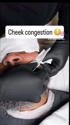 Deep Cheek Blackhead Extraction – Satisfying Close-Up