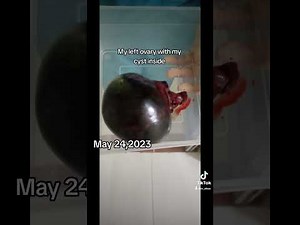 Ovarian Cysts- (Laparoscopic surgery)