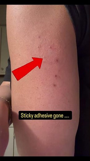Removing my Dexcomg7 sensor!! but getting that adhesive off is tricky!! ‪@dexcomCGM‬ @dexcom