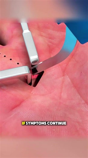 Trigger finger surgery #triggers #triggerfinger #triggered #medicaleducation #medical